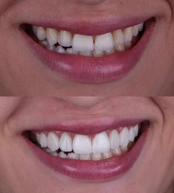 Antes e depois — caso 1