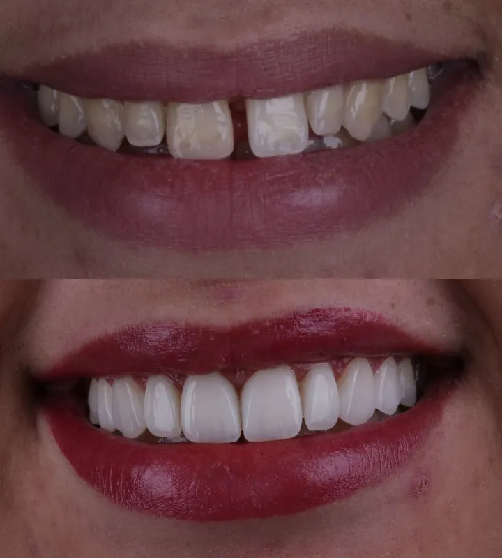Antes e depois — caso 5