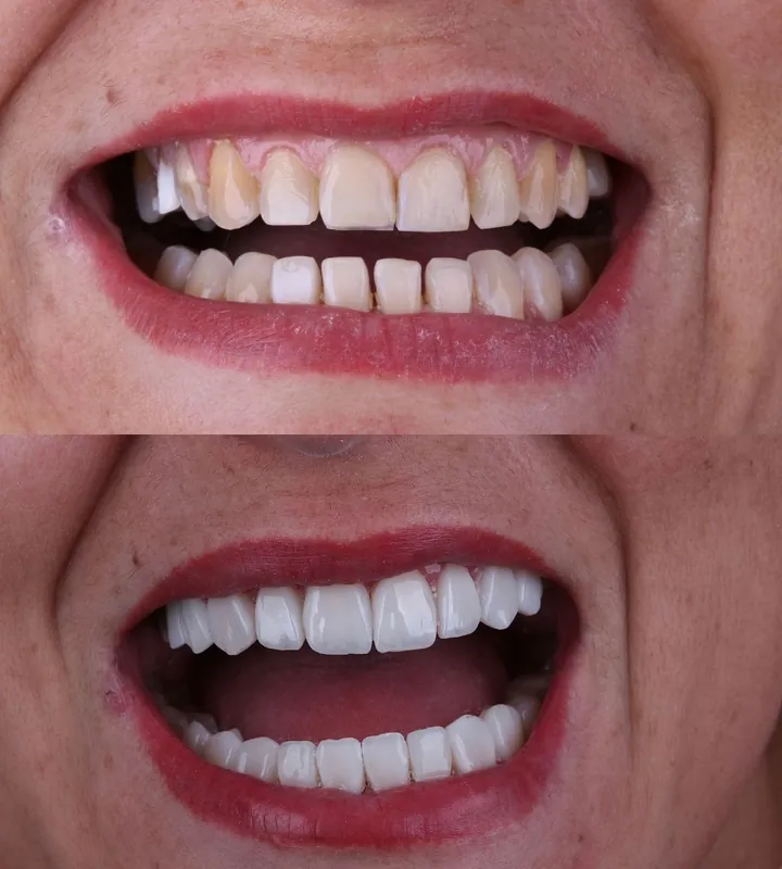 Antes e depois — caso 6