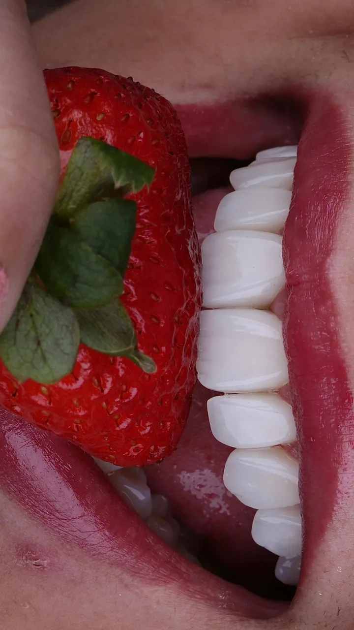 Sorriso com facetas em resina — caso 5